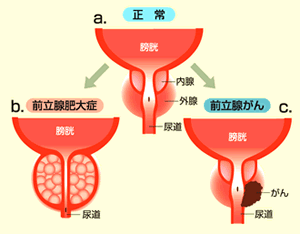 前立腺肥大症