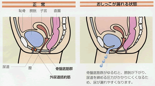 腹圧性尿失禁