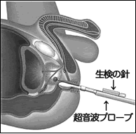 腹圧性尿失禁